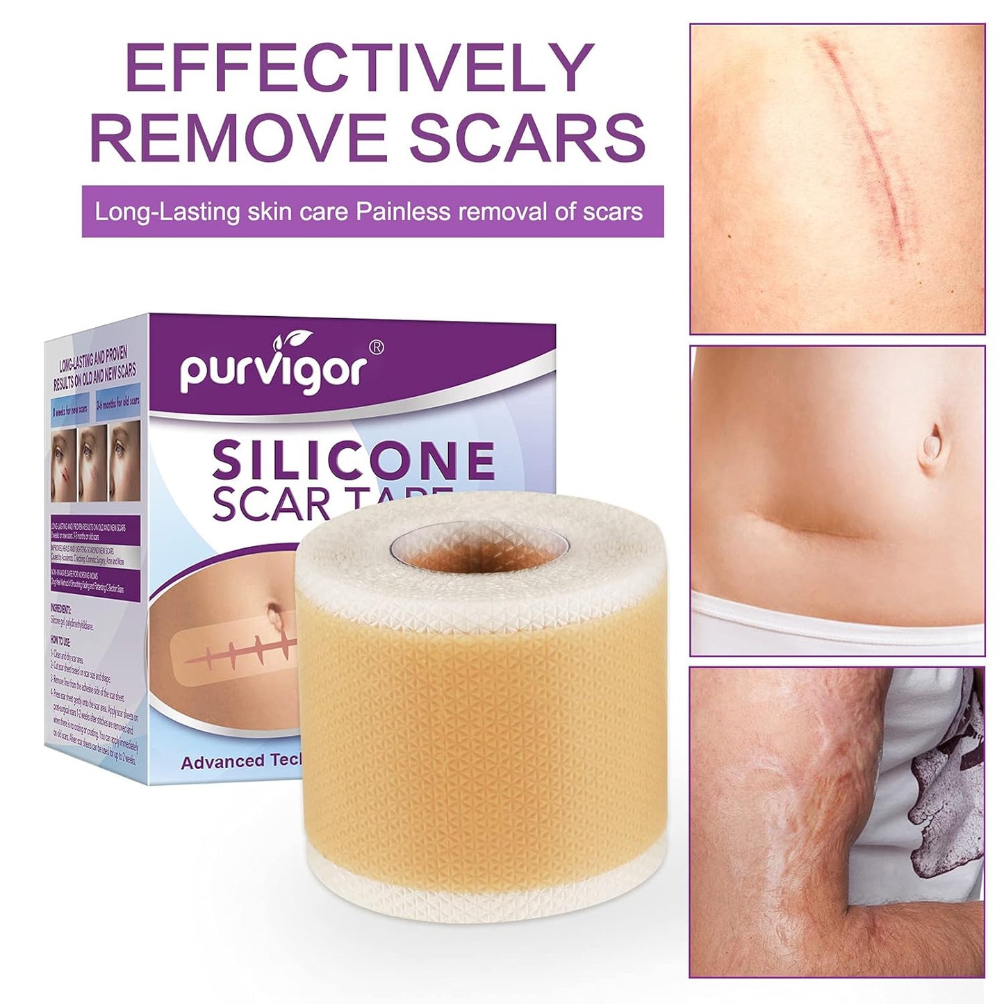 Purvigor Silicone Scar Tape Roll